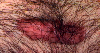 Keloids and hypertrophic scars