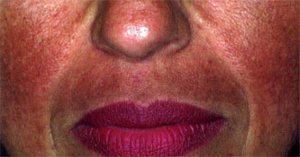 Melasma (chloasma, mask of pregnancy)