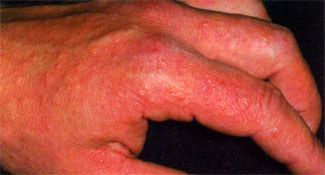 Polymorphous light eruption