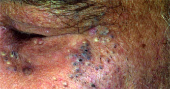 Sun-damaged skin, photoaging