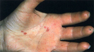 Scleroderma