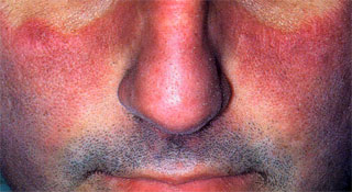 Acute cutaneous lupus erythematosus