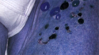 Bullous pemphigoid