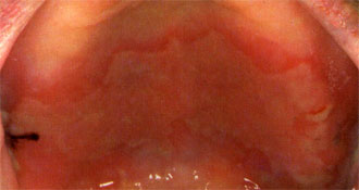 Pemphigus vulgaris