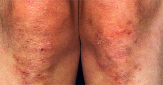 Dermatitis herpetiformis