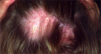 alopecia areata