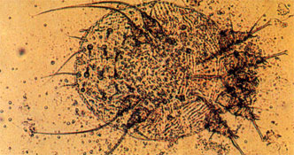 Scabies