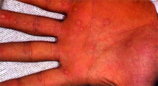 Schamberg disease (Schamberg purpura)