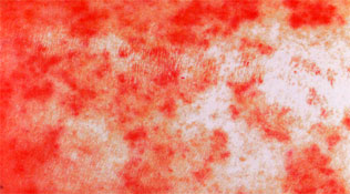 Stevens-Johnson syndrome