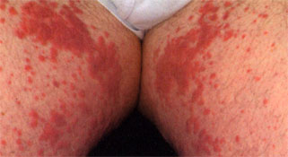 Cutaneous drug eruptions