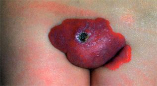 Hemangiomas of infancy