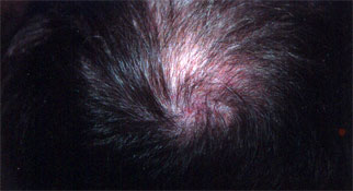 Androgenic alopecia (male pattern baldness)