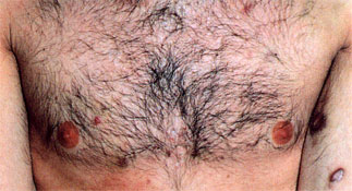 Kaposi sarcoma