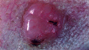 Basal cell carcinoma