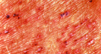 Angiokeratoma 