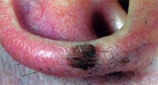 Malignant melanoma, lentigo maligna
