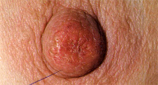 Paget disease of the breast