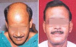 hair transplant