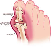 Gout replacement surgery in india