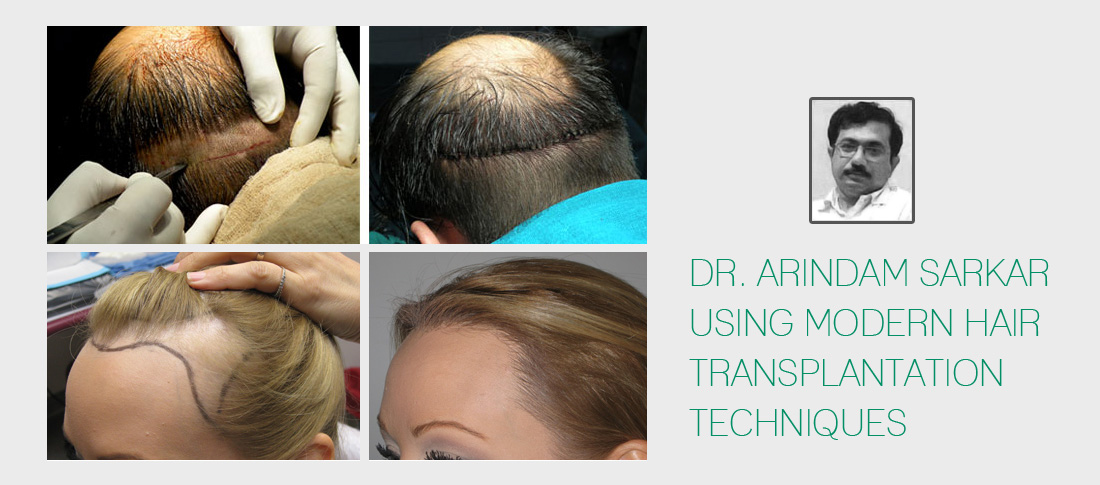 Hair Transplant in Bangladesh, Hair Transplant Cost