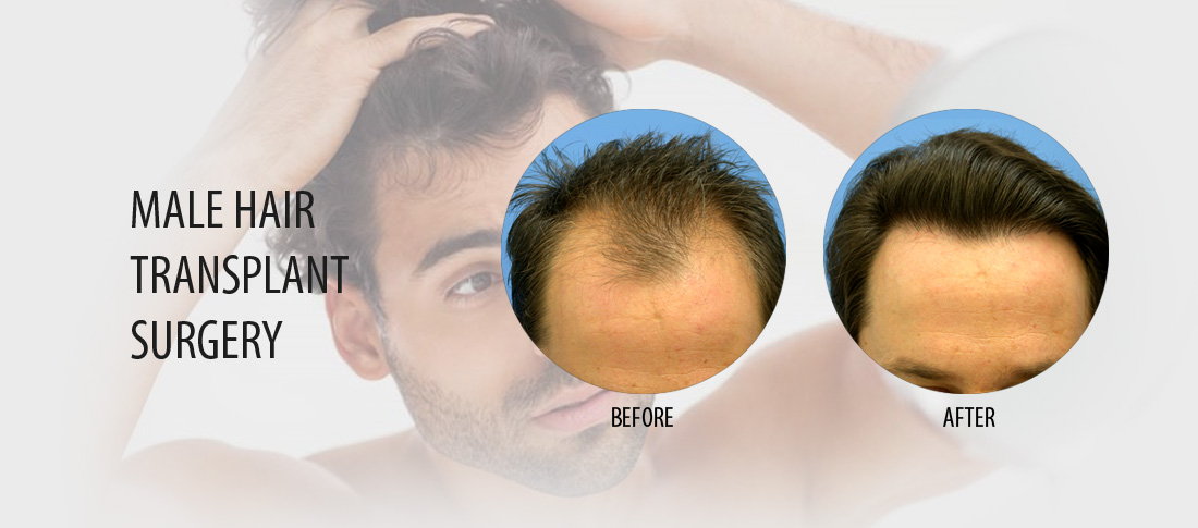 male hair transplant surgery