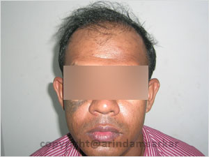 Hair Transplant