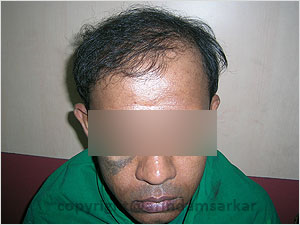 Hair Transplant