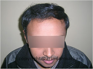 Hair Transplant