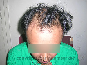 Hair Transplant