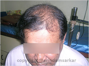 Hair Transplant