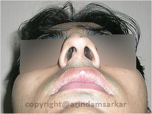 Cleft lip nose