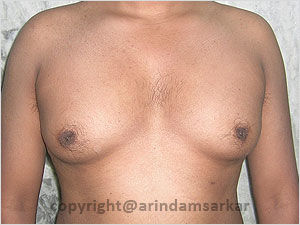 Dr. Arindam Sarkar Gynaecomastia