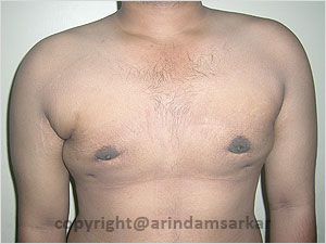 Dr. Arindam Sarkar Gynaecomastia