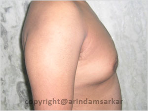 Dr. Arindam Sarkar Gynaecomastia