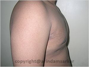 Dr. Arindam Sarkar Gynaecomastia