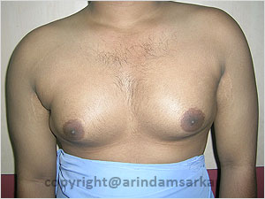 Dr. Arindam Sarkar Gynaecomastia