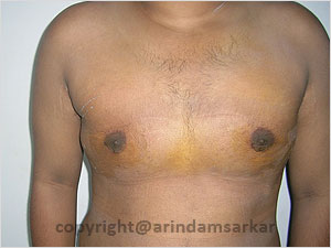 Dr. Arindam Sarkar Gynaecomastia