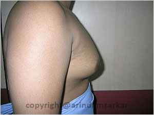 Dr. Arindam Sarkar Gynaecomastia