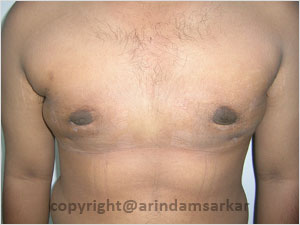 Dr. Arindam Sarkar Gynaecomastia