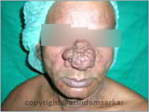 Dr. Arindam Sarkar Gynaecomastia