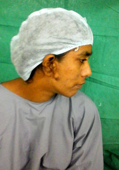 Dr. Arindam Sarkar Gynaecomastia