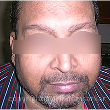 Eye Brow Transplant