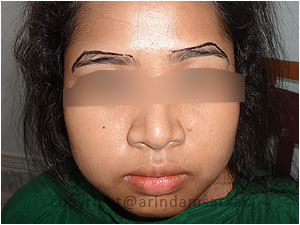 Eye Brow Transplant