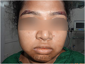 Eye Brow Transplant