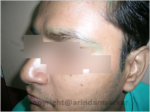 Eye Brow Transplant