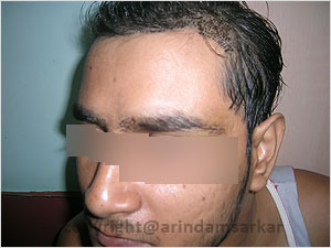 Eye Brow Transplant