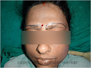 Eye Brow Transplant