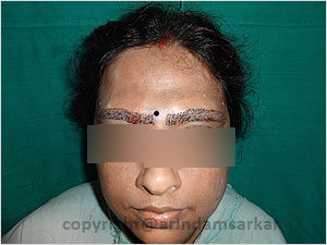 Eye Brow Transplant