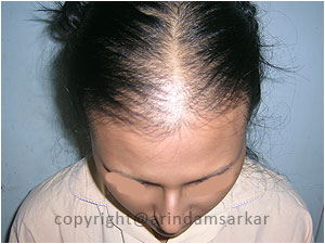 Hair Transplant