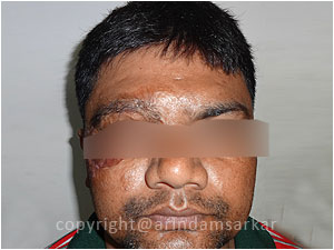 Eye Brow Transplant